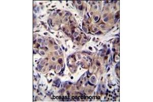 GEA3 Antibody (C-term) (ABIN390107 and ABIN2840619) immunohistochemistry analysis in forlin fixed and paraffin embedded hun breast carcino followed by peroxidase conjugation of the secondary antibody and DAB staining. (MAGEA3 anticorps  (C-Term))