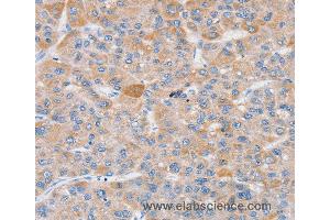 Immunohistochemistry of Human liver cancer using SLC25A13 Polyclonal Antibody at dilution of 1:35 (slc25a13 anticorps)