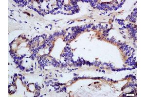 Formalin-fixed and paraffin embedded human colon cancer tissue labeled with Rabbit Anti-DHDH Polyclonal Antibody, Unconjugated (ABIN2559590) at 1:200 followed by conjugation to the secondary antibody and DAB staining (DHDH anticorps  (AA 281-334))