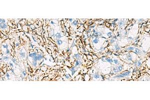Immunohistochemistry of paraffin-embedded Human liver cancer tissue using ACTC1 Polyclonal Antibody at dilution of 1:55(x200) (ACTC1 anticorps)