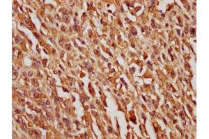 IHC image of ABIN7163445 diluted at 1:100 and staining in paraffin-embedded human melanoma cancer performed on a Leica BondTM system. (PEDF anticorps  (AA 128-418))
