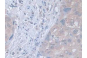 IHC-P analysis of Human Breast cancer Tissue, with DAB staining. (LDOC1 anticorps  (AA 1-146))