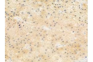 ABIN6257072 and ABIN6273592 at 1/100 staining human hepatocellular carcinoma by IHC-P. (CPEB1 anticorps  (Internal Region))