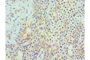 Immunohistochemistry of paraffin-embedded human breast cancer using ABIN7155972 at dilution of 1:100 (HYAL3 anticorps  (AA 198-417))