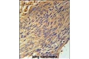 CPEB4 Antibody (N-term) (ABIN651815 and ABIN2840408) immunohistochemistry analysis in formalin fixed and paraffin embedded human lung carcinoma followed by peroxidase conjugation of the secondary antibody and DAB staining.