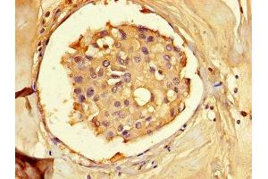 Immunohistochemistry of paraffin-embedded human breast cancer using ABIN7143311 at dilution of 1:100 (AHCY anticorps  (AA 2-432))