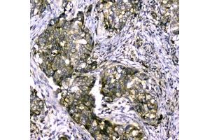 IHC testing of FFPE human breast cancer tissue with MYBPC3 antibody at 1ug/ml. (MYBPC3 anticorps)