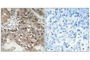 Immunohistochemistry analysis of paraffin-embedded human breast carcinoma tissue using MAP3K7 (Ab-187) antibody. (MAP3K7 anticorps  (Thr187))