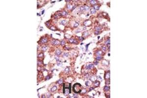 Formalin-fixed and paraffin-embedded human cancer tissue reacted with the primary antibody, which was peroxidase-conjugated to the secondary antibody, followed by AEC staining.