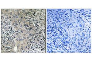Immunohistochemistry analysis of paraffin-embedded human cervix carcinoma tissue using COPZ1 antibody. (COPZ1 anticorps  (N-Term))