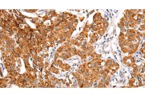 Immunohistochemistry of paraffin-embedded Human lung cancer using TRAF5 Polyclonal Antibody at dilution of 1:30 (TRAF5 anticorps)