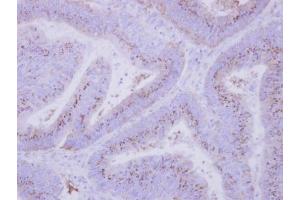 IHC-P Image Immunohistochemical analysis of paraffin-embedded human colon carcinoma, using INPP5F, antibody at 1:500 dilution. (INPP5F anticorps)