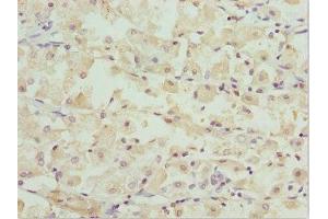 Immunohistochemistry of paraffin-embedded human gastric cancer using ABIN7162247 at dilution of 1:100 (OPA3 anticorps  (AA 25-179))