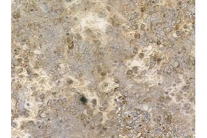 ABIN6255084 and ABIN6267182 at 1/100 staining human melanoma by IHC-P.