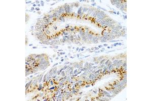 Immunohistochemistry of paraffin-embedded human colon carcinoma using FAM3B antibody at dilution of 1:100 (40x lens). (FAM3B anticorps)