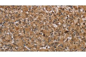 Immunohistochemistry of paraffin-embedded Human prostate cancer tissue using IKBIP Polyclonal Antibody at dilution 1:40 (IKbIP anticorps)