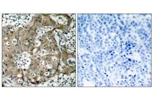 Immunohistochemical analysis of paraffin-embedded human breast carcinoma tissue using FKHR (Ab-319) antibody (E021161). (FOXO1 anticorps)