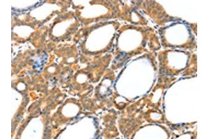 The image on the left is immunohistochemistry of paraffin-embedded Human thyroid cancer tissue using ABIN7130819(RASAL1 Antibody) at dilution 1/20, on the right is treated with fusion protein. (RASAL1 anticorps)