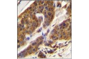 Immunohistochemistry analysis in Formalin Fixed, Paraffin Embedded Human bladder carcinoma stained with CFD Antibody (N-term) followed by peroxidase conjugation of the secondary antibody and DAB staining. (Adipsin anticorps  (N-Term))