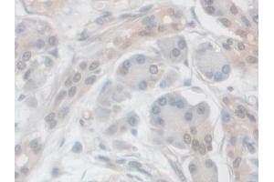 IHC-P analysis of Human Pancreatic cancer Tissue, with DAB staining. (VPS37A anticorps  (AA 1-397))