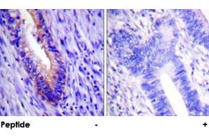 Immunohistochemical analysis of paraffin-embedded human colon carcinoma tissue using EIF4G1 polyclonal antibody . (EIF4G1 anticorps)