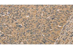 Immunohistochemistry of paraffin-embedded Human cervical cancer tissue using PRDM14 Polyclonal Antibody at dilution 1:30 (PRDM14 anticorps)