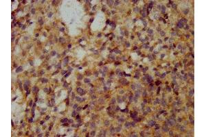IHC image of ABIN7175671 diluted at 1:200 and staining in paraffin-embedded human ovarian cancer performed on a Leica BondTM system.