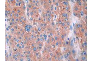 IHC-P analysis of Human Liver cancer Tissue, with DAB staining. (CUBN anticorps  (AA 3511-3623))