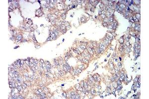 Immunohistochemical analysis of paraffin-embedded stomach cancer tissues using RUNX3 mouse mAb with DAB staining.