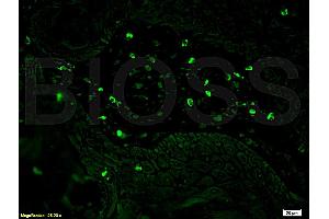 Formalin-fixed and paraffin embedded human oral squamous cell carcinoma labeled Anti-CD8 Polyclonal Antibody, Unconjugated (ABIN671391) at 1:200, followed by conjugation to the secondary antibody Goat Anti-Rabbit IgG, FITC conjugated used at 1:200 dilution for 40 minutes at 37°C.