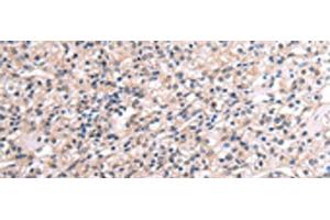 Immunohistochemistry of paraffin-embedded Human liver cancer tissue using RNF115 Polyclonal Antibody at dilution of 1:45(x200) (RNF115 anticorps)