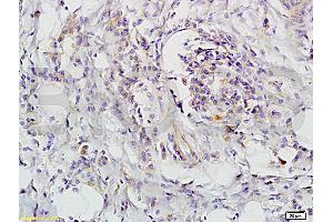 Formalin-fixed and paraffin-embedded human colon carcinoma labeled with Rabbit Anti-CD118 Polyclonal Antibody, unconjugated  (ABIN686827)  1: 200 followed by incubation with conjugated secondary antibody and DAB staining (LIFR anticorps  (AA 451-580))