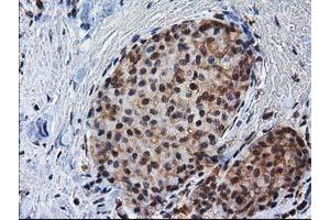 Immunohistochemical staining of paraffin-embedded Adenocarcinoma of Human breast tissue using anti-NHEJ1 mouse monoclonal antibody. (NHEJ1 anticorps)