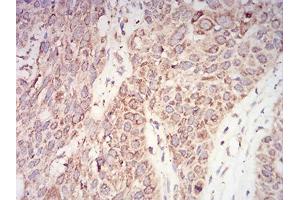 Immunohistochemical analysis of paraffin-embedded esophageal cancer tissues using AKT1 mouse mAb with DAB staining.