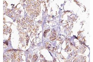 ABIN6275245 at 1/100 staining Human breast cancer tissue by IHC-P.
