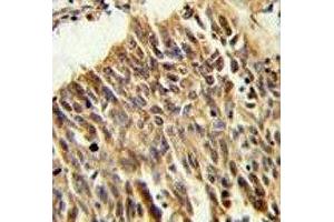HIF1A antibody IHC analysis in formalin fixed and paraffin embedded lung carcinoma.