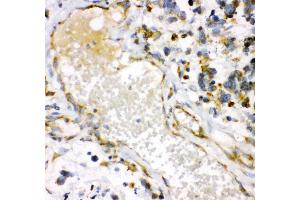 Anti- HMOX1 antibody, IHC(P) IHC(P): Human Lung Cancer Tissue (HMOX1 anticorps  (AA 1-288))