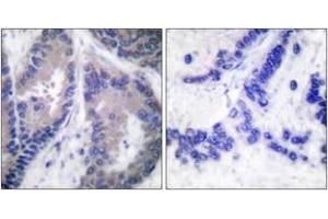 Immunohistochemistry analysis of paraffin-embedded human lung carcinoma tissue, using Collagen alpha1 XVIII Antibody. (COL18A1 anticorps  (AA 1301-1350))