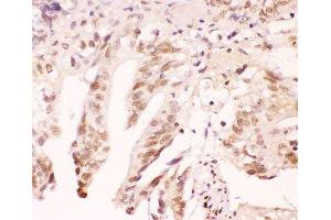 IHC-P: ATF1 antibody testing of human intestinal cancer tissue