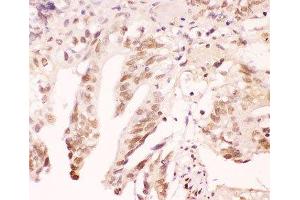 IHC-P: ATF1 antibody testing of human intestinal cancer tissue (AFT1 anticorps  (AA 1-271))
