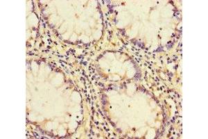Immunohistochemistry of paraffin-embedded human colon cancer using ABIN7164149 at dilution of 1:100 (PCF11 anticorps  (AA 409-604))