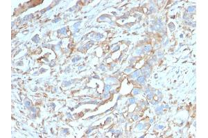 Formalin-fixed, paraffin-embedded human Breast Carcinoma stained with PD-L1-Monospecific Mouse Monoclonal Antibody (PDL1/2746).