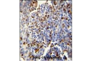 FOSL2 antibody (Center) (ABIN654925 and ABIN2844568) immunohistochemistry analysis in formalin fixed and paraffin embedded human lung carcinoma followed by peroxidase conjugation of the secondary antibody and DAB staining. (FOSL2 anticorps  (AA 95-122))