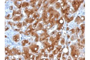 Formalin-fixed, paraffin-embedded human Hepatocellular Carcinoma stained with Serum Amyloid A Mouse Monoclonal Antibody (SAA/326). (SAA anticorps)