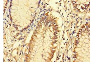 Immunohistochemistry of paraffin-embedded human colon cancer using ABIN7165398 at dilution of 1:100 (FAM135B anticorps  (AA 801-1100))