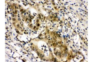 Anti- EIF6 Picoband antibody,IHC(P) IHC(P): Human Intestinal Cancer Tissue (EIF6 anticorps  (AA 66-210))