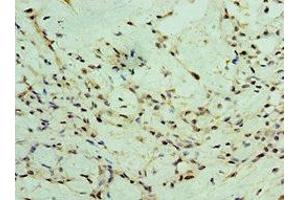 Immunohistochemistry of paraffin-embedded human breast cancer using ABIN7176056 at dilution of 1:100
