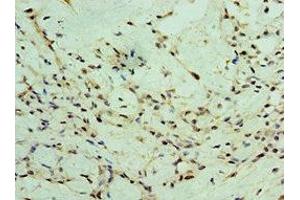 Immunohistochemistry of paraffin-embedded human breast cancer using ABIN7176056 at dilution of 1:100 (ZEB2 anticorps  (AA 1050-1214))