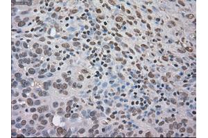 Immunohistochemical staining of paraffin-embedded Adenocarcinoma of colon tissue using anti-NTRK3mouse monoclonal antibody. (NTRK3 anticorps)
