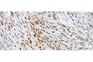Immunohistochemistry of paraffin-embedded Human lung cancer tissue using CNOT7 Polyclonal Antibody at dilution of 1:55(x200) (CNOT7 anticorps)